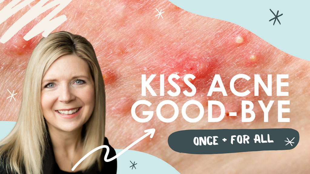 Kiss Your Acne Good-Bye Once + For All