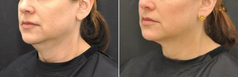 "Neck No More" Package (3 Sessions)